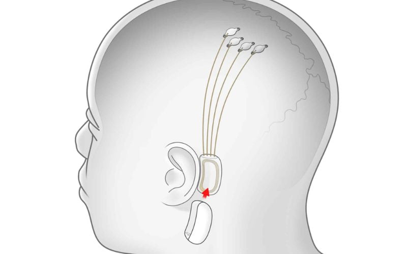 Thành tựu đột phá trong công nghệ y tế giúp người bị liệt lấy lại giọng nói nhờ cấy chip vào não